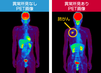 PET CTとPETの違い｜基礎知識＆治療説明｜PET検査ネット｜PET検査  - pet検査 画像