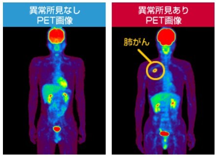 PET/CT検査［PET検査＋CT検査］（頭頂部～大腿基部）の写真